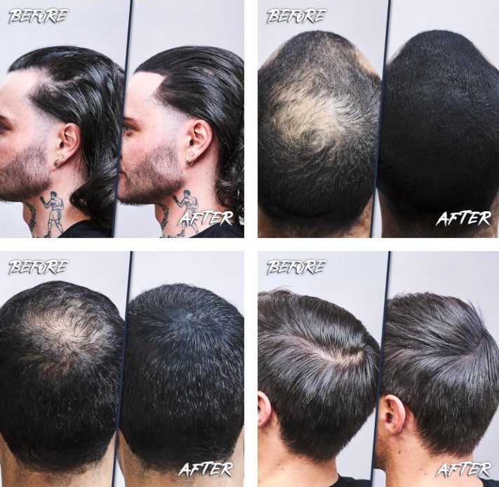 Hair loss subscription UK